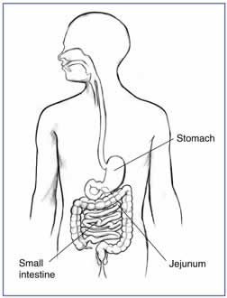 Gastroparesis diagram. Gastroparesis diagram.