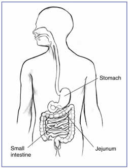 Gastroparesis diagram.